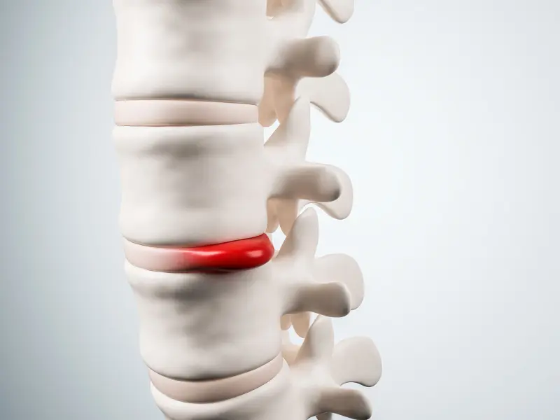 Disc Injury Treatment Near Me in Phoenix, AZ. Disc Injury Pain From Bulged Disc.