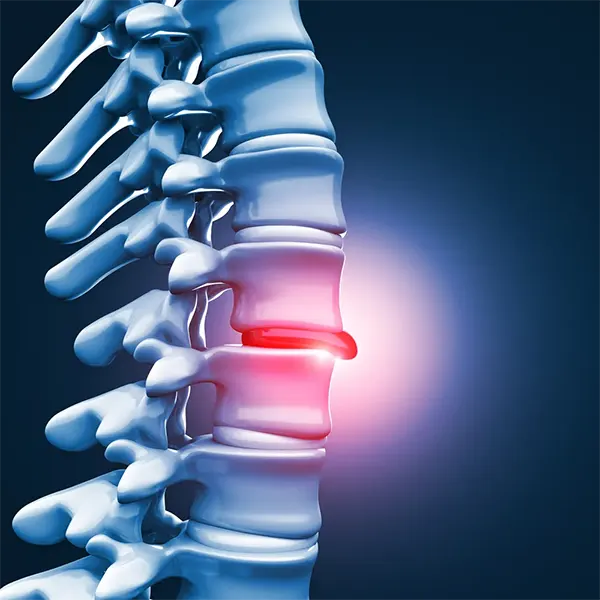 Disc Injury Treatment Near Me in Phoenix, AZ. Chiropractor For Herniated Bugled Disc Injury Pain Relief.